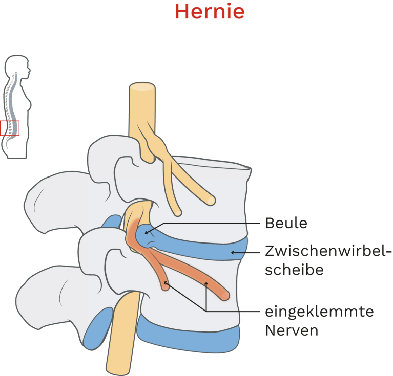 Bandscheibenvorfall Rücken