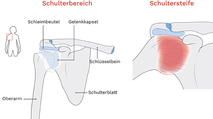 Frozen Shoulder (Schultersteife) Behandlung | Bergman Clinics