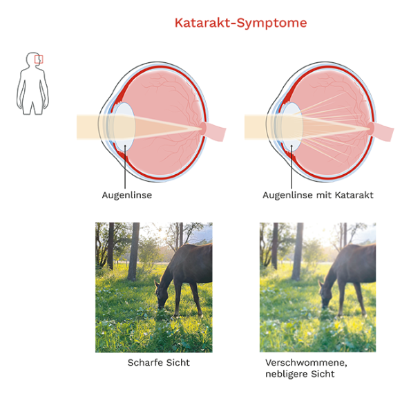 Unterschied scharfes Sehen und Sehen mit Katarakt