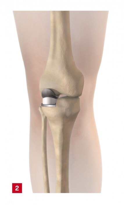 Halbe Knieprothese