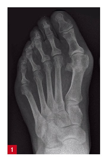 Hallux Valgus