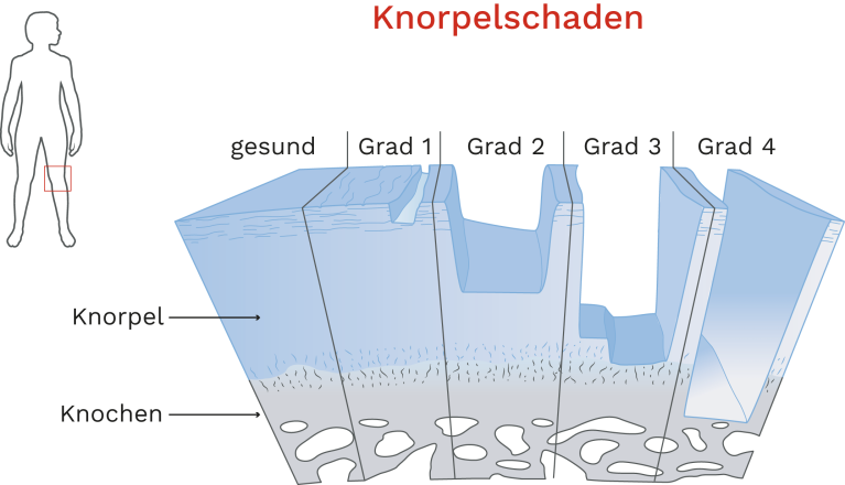 Knorpelschaden Knie