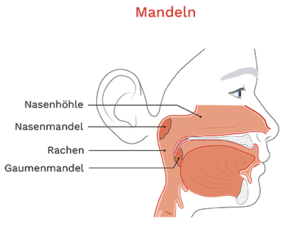 Mandeln entfernen bei Kindern