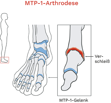MTP-1-Arthrodese