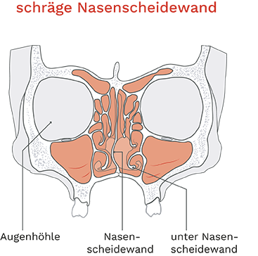Schräge Nasenscheidewand