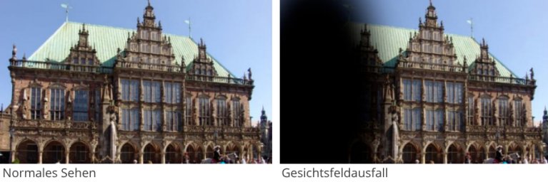 Unterschiedliches Sehen mit und ohne Netzhautproblemen