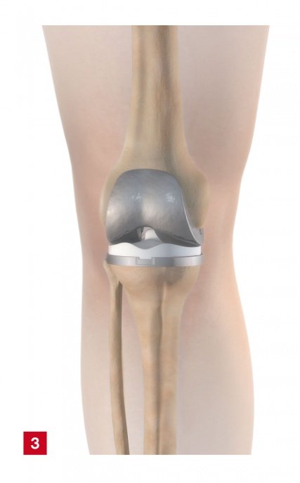 Totaler Kniegelenkersatz